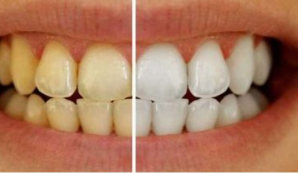 بطرق طبيعية إزالة الجير من الأسنان. تعرف عليها